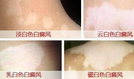 白癜风吃小瓜好吗,白癜风患者适宜食用小瓜吗？营养与健康解析