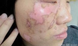 白癜风吃小瓜好吗,白癜风患者适宜食用小瓜吗？营养与健康解析